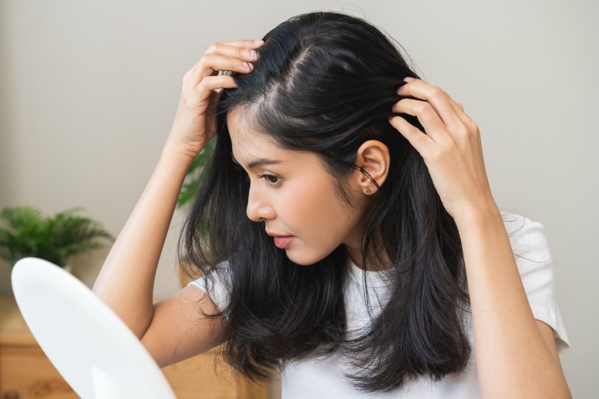 Veja as causas e os tratamentos para a alopecia areata